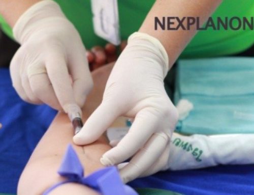 NEXPLANON: An Overview of Birth Control Implant