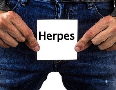 Herpes with genital Living with