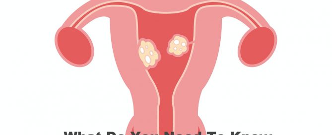 What Do You Need To Know About Uterine Fibroids?