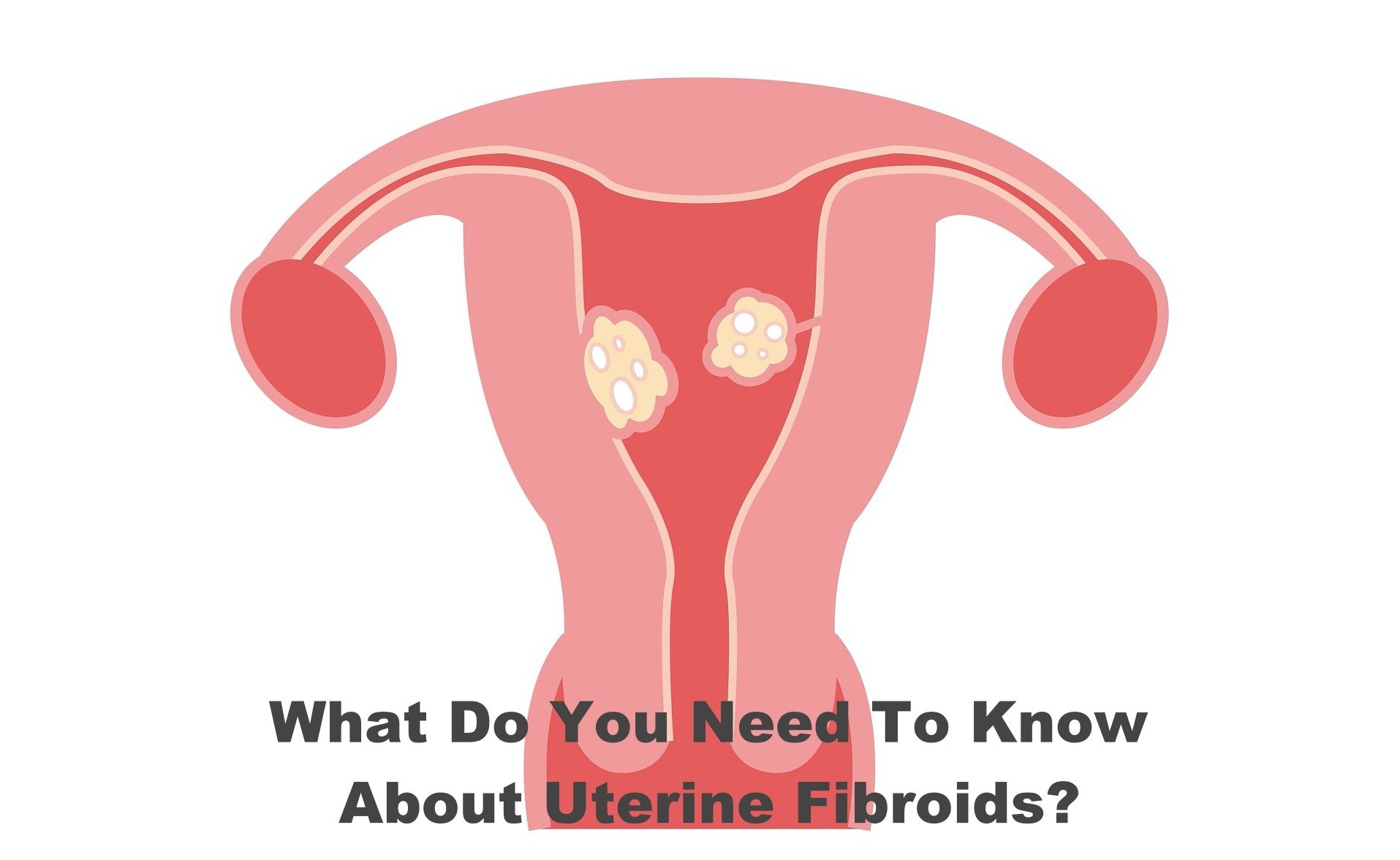 What Do You Need To Know About Uterine Fibroids?